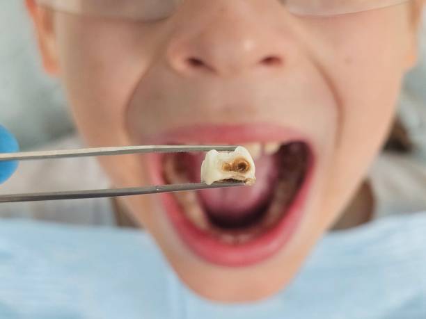 Best Emergency Broken Tooth Repair in Abilene, KS